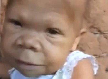 A 30 ans, elle ressemble à un bébé de 9 mois