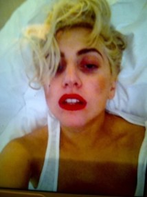 Photo : Lady Gaga et les conséquences de son accident