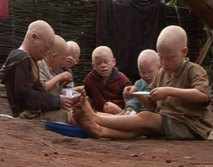 Plainte: Les Albinos veulent traduire en justice les criminels 