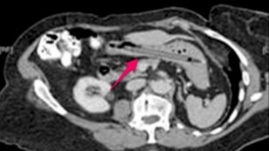 Un stylo dans son estomac pendant 25 ans!