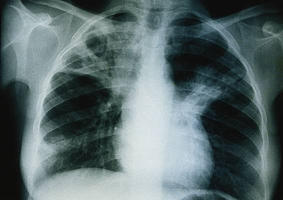 Thiès : La tuberculose tue : Les autorités jugent la situation non alarmante