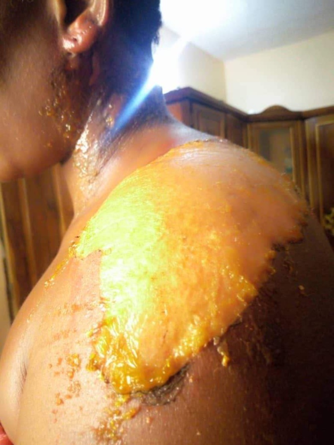 VIDEO - Diakhaye: Une femme verse du thé chaud sur sa coépouse