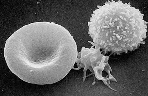 Une nouvelle maladie auto-immune aussi puissante que le VIH