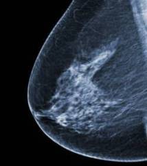 Cancer du sein : 75% des cas détectés tardivement
