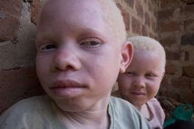 Quand les Albinos du Sénégal se fâchent