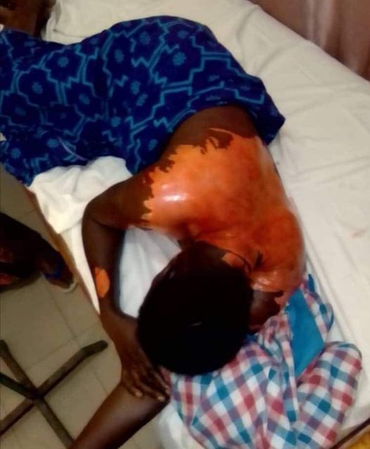 Darou Mouhty: Ebouillantée par sa coépouse A. N., le chantage répugnant d'un mari