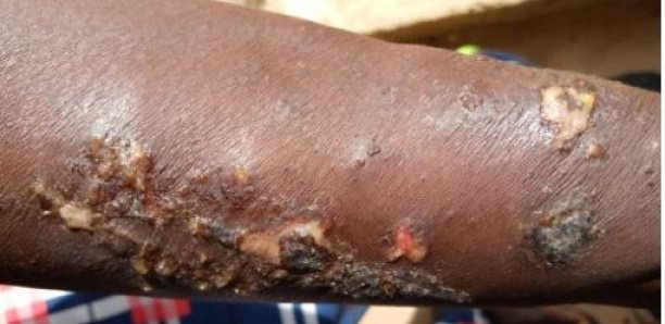 Maladie mystérieuse: Les femmes de Ndayane ont trouvé le "remède", en deux jours,...
