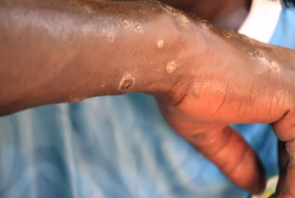 Maladie des pêcheurs: « Une contamination chimique ponctuelle, pas un effet viral ou dû aux algues» selon Brahima Cissé, de Greenpeace Afrique