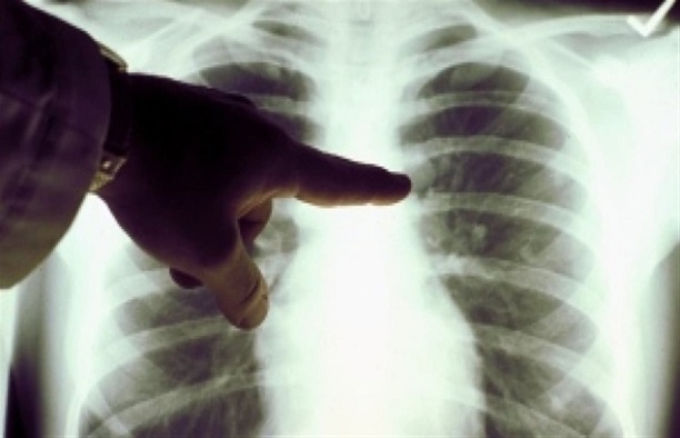 Santé - Elimination de la tuberculose en 2035: L’Etat mise sur la prise en charge des cas contagieux