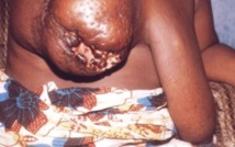 Faute de système d’enregistrement des cas relevant de la maladie :  Le Sénégal n'a pas de caméléon dans la lutte contre le cancer