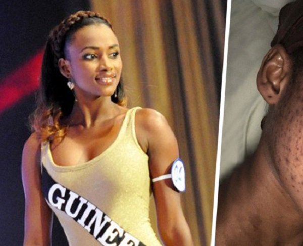 Victime d’une réaction allergique causée par des produits de beauté, la Miss Cedeao 2012 méconnaissable (Photos)