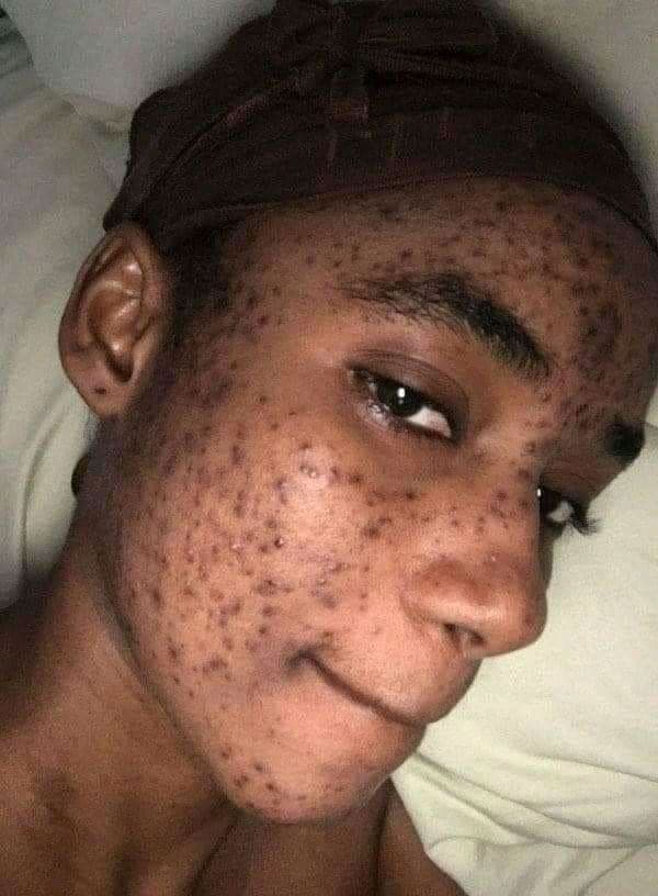 Victime d’une réaction allergique causée par des produits de beauté, la Miss Cedeao 2012 méconnaissable (Photos)