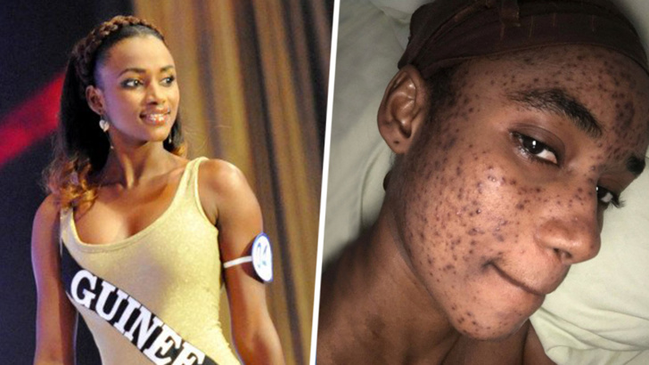 Victime d’une réaction allergique causée par des produits de beauté, la Miss Cedeao 2012 méconnaissable (Photos) Victime d’une réaction allergique causée par des produits de beauté, la Miss Cedeao 2012 méconnaissable (Photos)