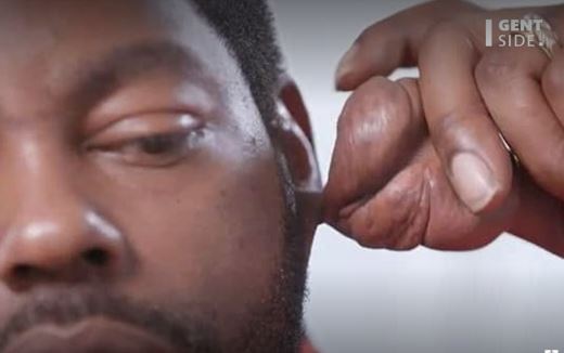 Histoire invraisemblable : un afro-américain se fait retirer un "testicule" de son oreille