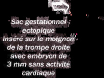 Lutte contre les grossesses d'adolescentes : une sociologue demande l'implication des ‘’grandes personnes’’