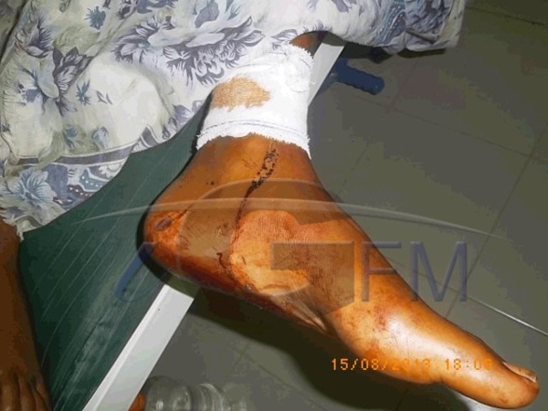 (Photos + Vidéos) Battue à coup de machette par son mari, Awa Dagnokho est sortie de l’hôpital