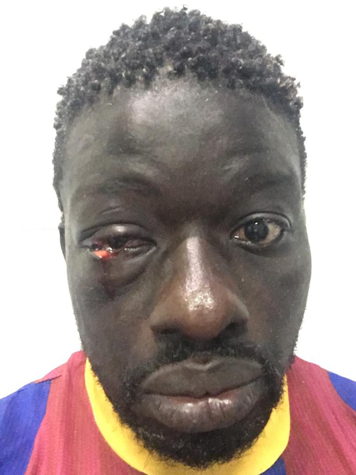 PHOTOS / Lutte: Zoss, blessé à l’oeil face à Alioune Seye 2