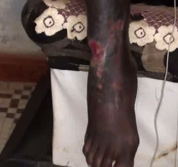 "Leral Aide et Action" : Cet homme risque de perdre sa jambe si on ne l’aide pas (Attention ! Âmes sensibles s'abstenir)
