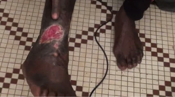 "Leral Aide et Action" : Cet homme risque de perdre sa jambe si on ne l’aide pas (Attention ! Âmes sensibles s'abstenir)