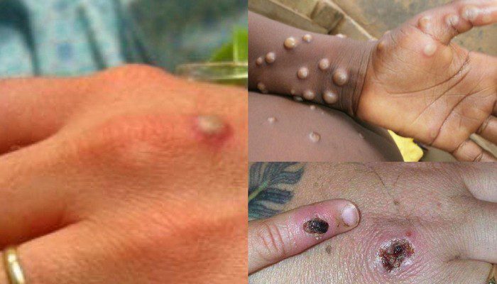 Ce qu’il faut savoir sur l’épidémie de variole du singe et ses différents modes de propagation