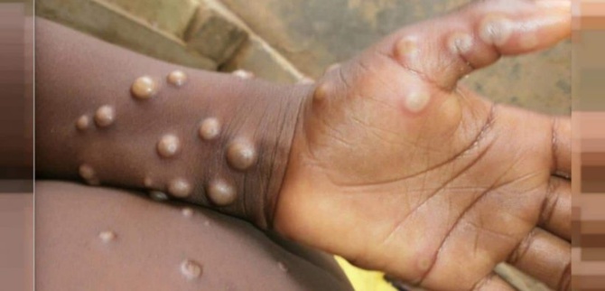 Variole du singe : L’Oms appelle à la vigilance après la contamination d’un chien