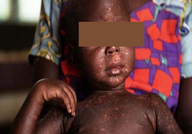 Dans la zone rouge avec 106 cas sur les 153 au Sénégal : Touba engage la riposte contre la rougeole