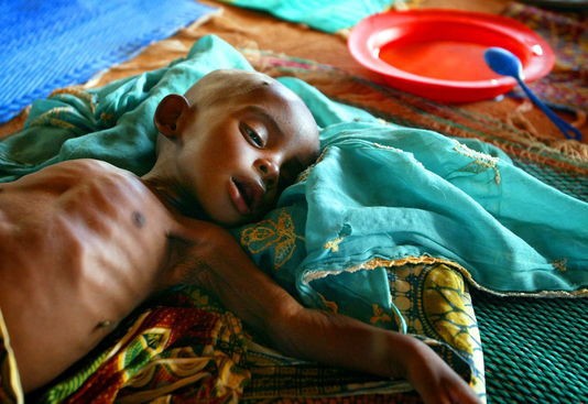 Tambacounda : La malnutrition, un mal bien présent