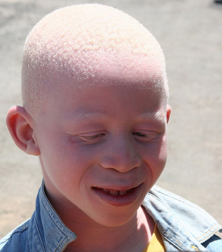 Discrimination et marginalisation Iliées aux fausses croyances: La dure condition d’être albinos à Tambacounda