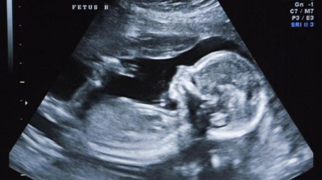 Des "fœtus" jumeaux découverts à l'intérieur d'un nouveau-né