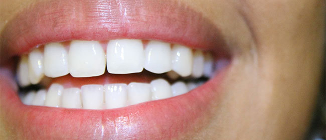 Le détartrage : Un soin indispensable à la santé de nos dents