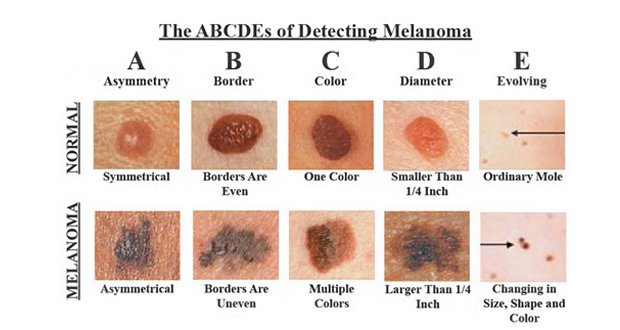 Comment reconnaître le cancer de la peau