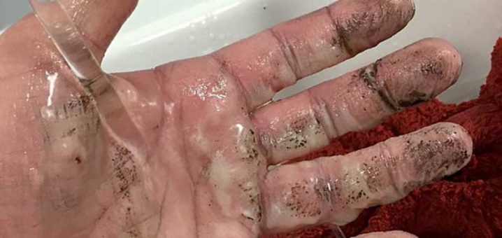 Elle souffre de terribles brûlures à cause du chargeur de sa batterie qui a explosé en pleine nuit: soyez prudents!