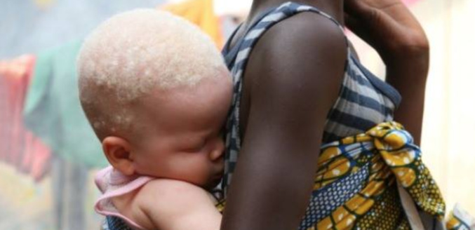 Au Malawi : un instituteur arrêté pour avoir tenté de vendre sa petite amie albinos