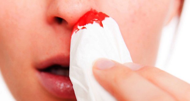 Astuces pour arrêter le saignement de nez