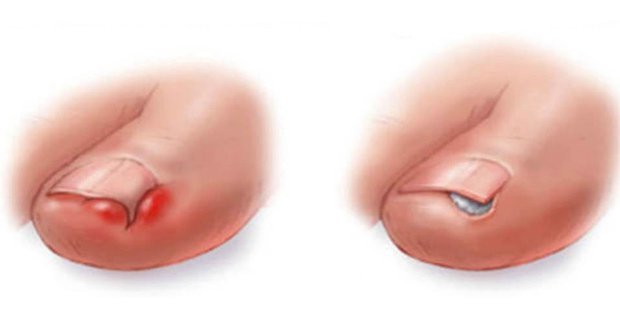 Voici comment se débarrasser d’un ongle incarné sans chirurgie
