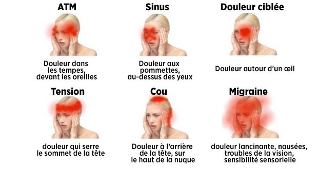 Apprenez à reconnaître les maux de tête dangereux