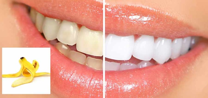 Comment blanchir mes dents avec une peau de banane