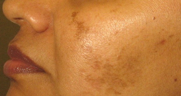 Débarrassez-vous des taches brunes,et de l’hyperpigmentation avec deux ingrédients