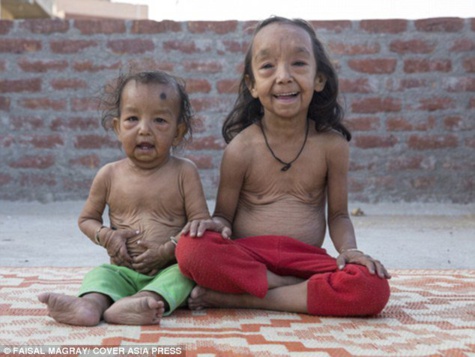 L'histoire de ces deux jeunes enfants Indiens ressemblant étrangement à « Benjamin Button » va vous bouleverser