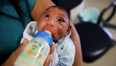 Bébés malformés: et si Zika n'était pas en cause?