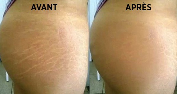 Voici comment se débarrasser naturellement des vergetures en 6 semaines !