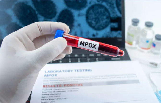 Cas de variole du singe détecté au Sénégal :  Le ministère confirme un cas de Mpox chez un étranger à Dakar