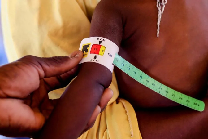 La malnutrition provoque une forme distincte de diabète, concluent des experts mondiaux