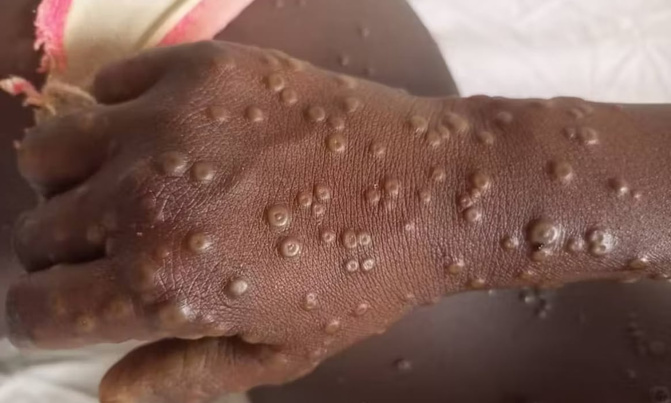 Santé-Alerte Mpox : quatre cas confirmés, 38 personnes sous surveillance