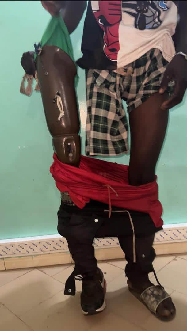 Karang : les Douanes saisissent 1 590 pilules d’ecstasy dissimulées dans une prothèse de jambe