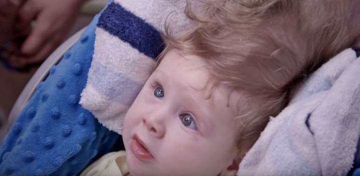 Un bébé nait avec le cerveau au-dessus du crâne