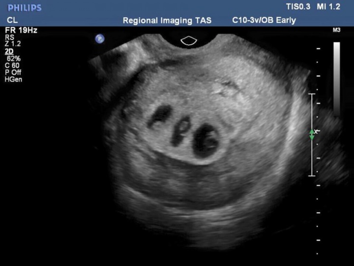 Naissance miraculeuse d'un bébé condamné à mourir dans l'utérus