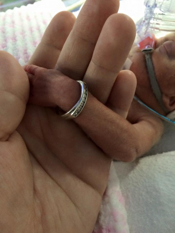 Un bébé naît si petit qu'une alliance peut lui entourer le bras !
