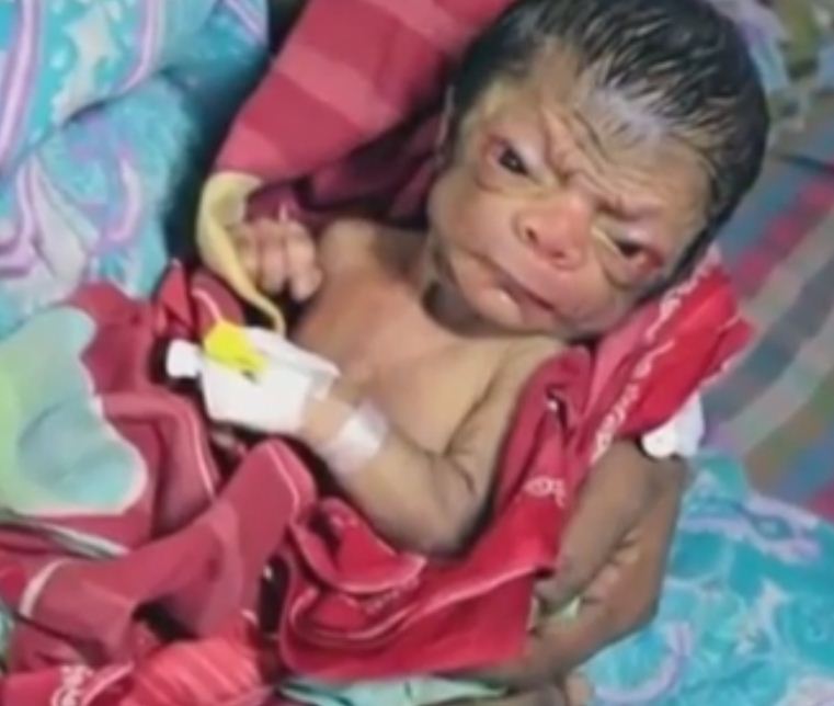 Un bébé vient au monde avec l'apparence d'un vieux de 80 ans