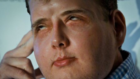 Le pompier tenait une conférence de presse mercredi à propos de sa greffe du visage